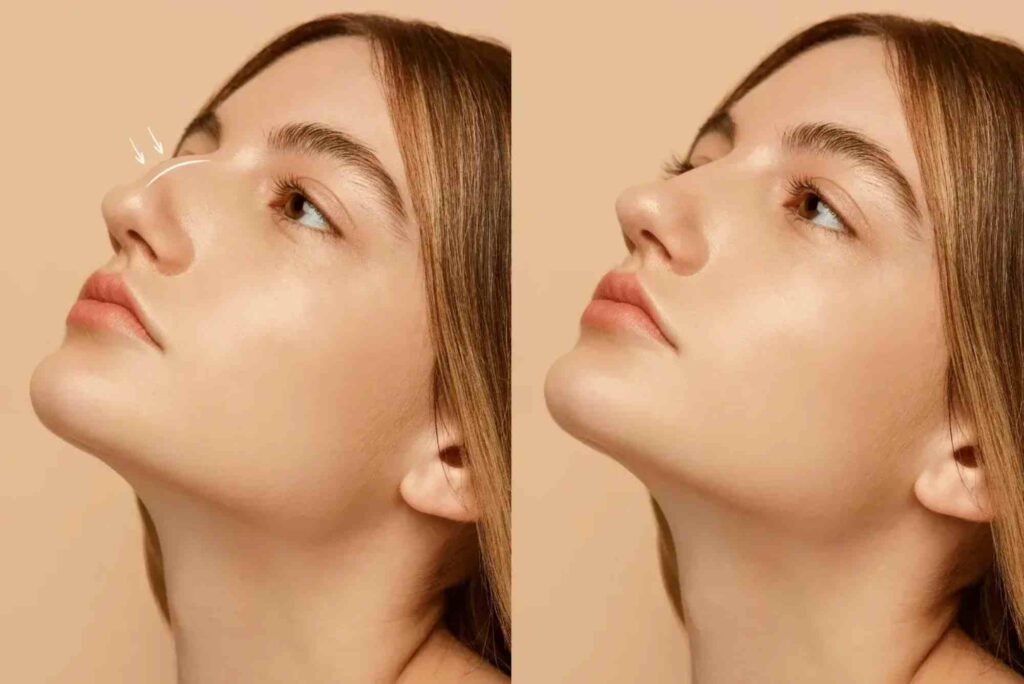 Practical Tips: Affects Rhinoplasty Turkey Price And Cost